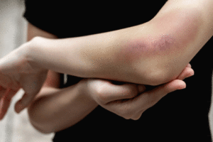 Man rubbing his bruised elbow